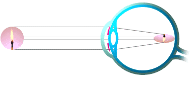 astigmate1
