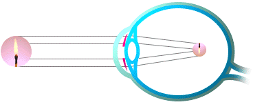 myopie1