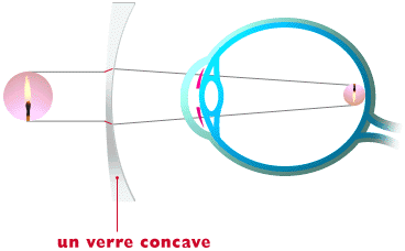Defauts visuels Arte Vista Opticiens